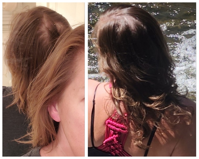 Hair Regrowth Pictures